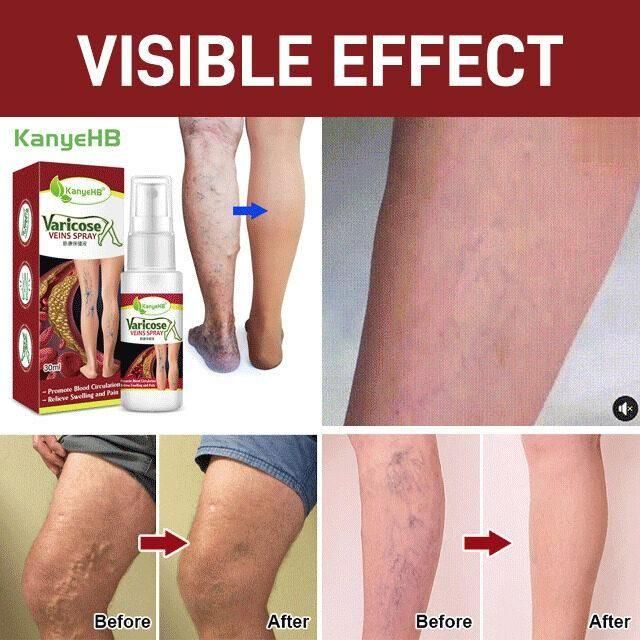 Vein Healing Varicose Veins Treatment Spray