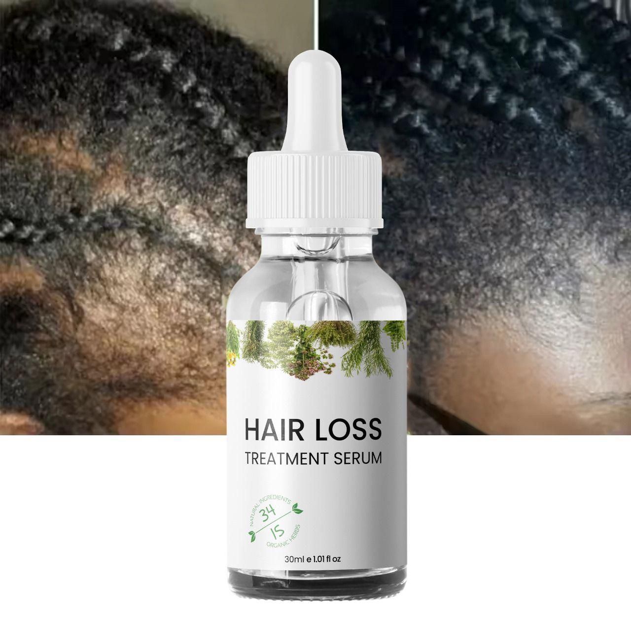 Hair Loss Treatment Serum 30Ml (Pack Of 2)